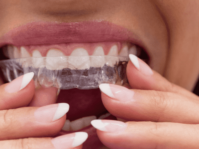 invisalign